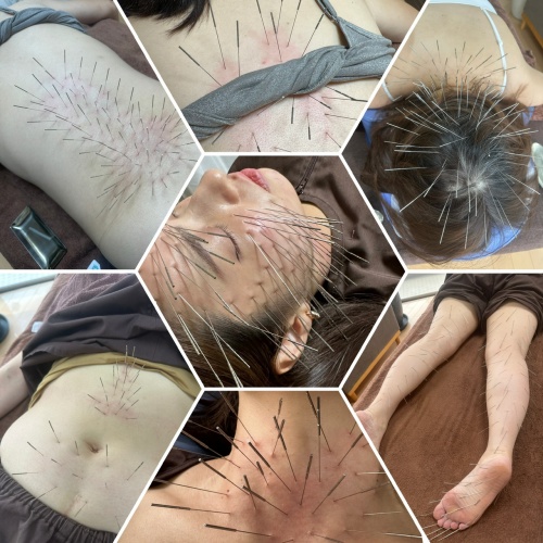 ルート治療90分(超全身)